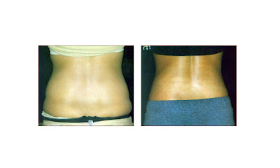 Ampollas de mesoterapia para adelgazar